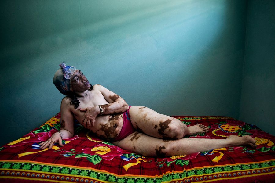 VItiligo.jpg